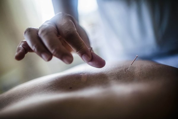 How Can Acupuncture Benefit in Treating Chronic Back Pain?